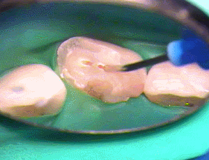 セラカルによる歯髄保護　2015.08.11.gif